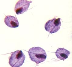 Trichomoniasis